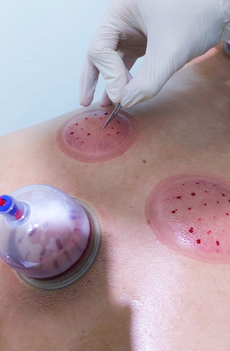 Séance de hijama (ventouses) sur le dos