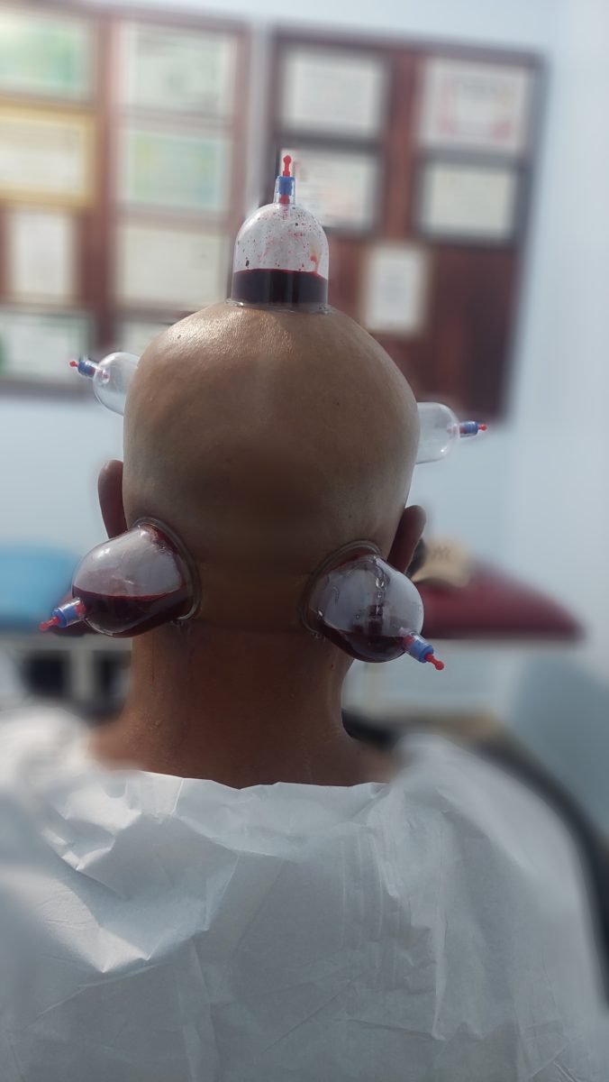 Pose de ventouses sur la tête et la nuque